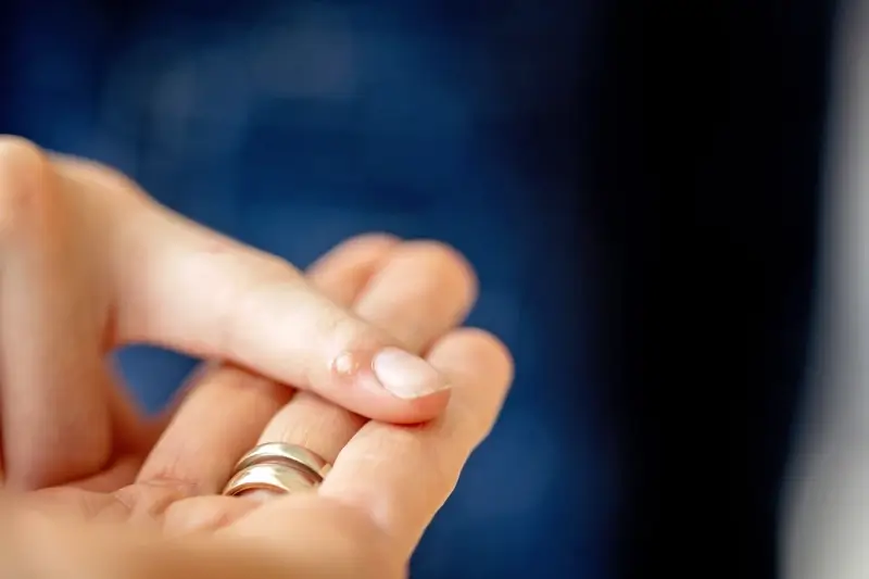 Jak usunąć kurzajkę kurzajki na stopach?